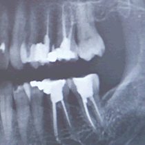 Endodontic Surgery